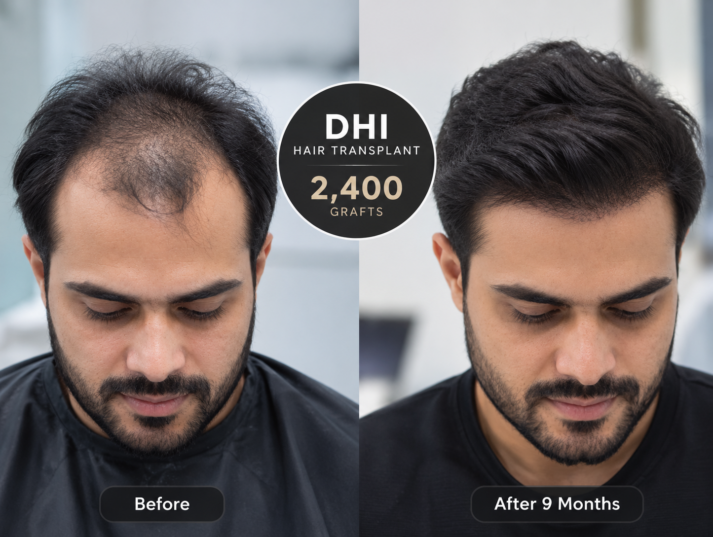 DHI Hair Transplant in Delhi